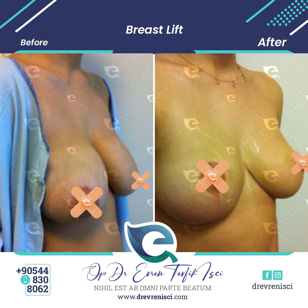 Breast lift 1