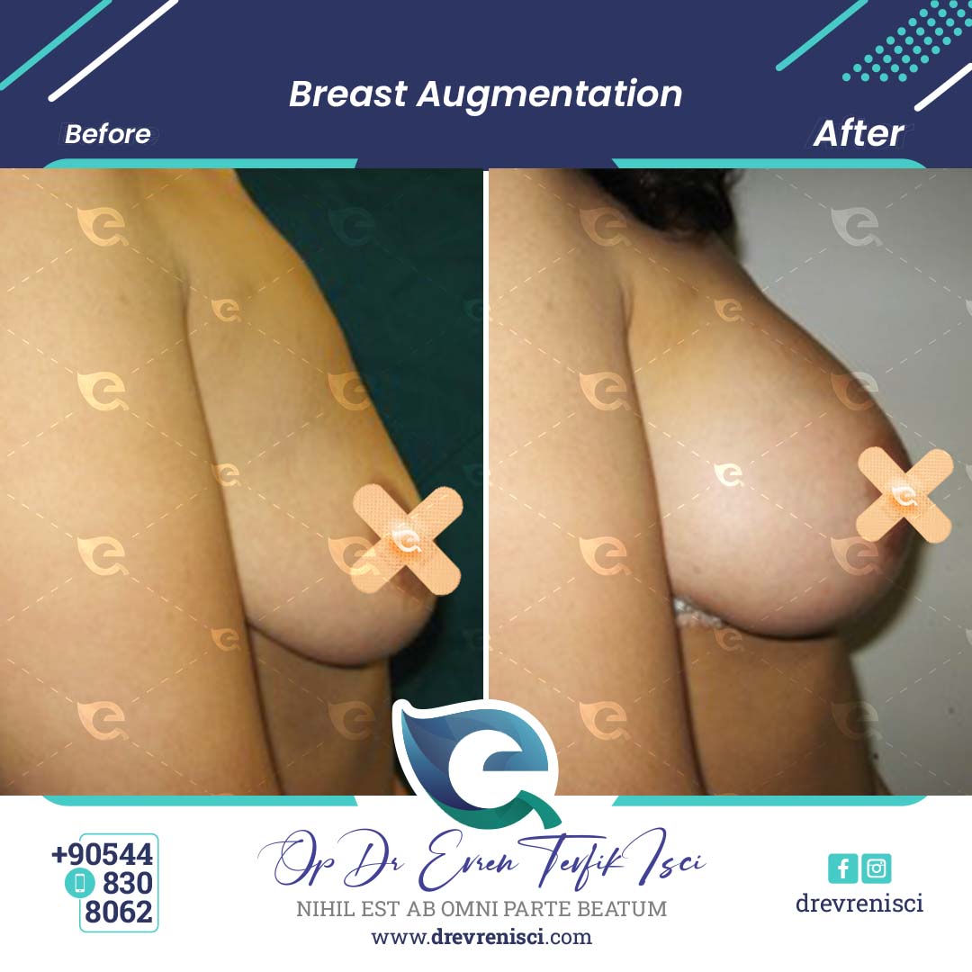 breast augmentation gallery 5