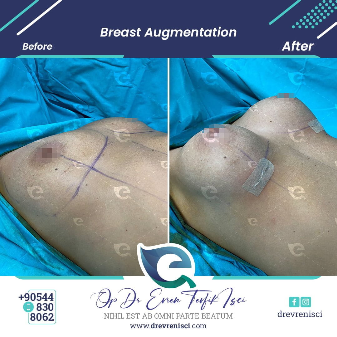 breast augmentation galleryyy