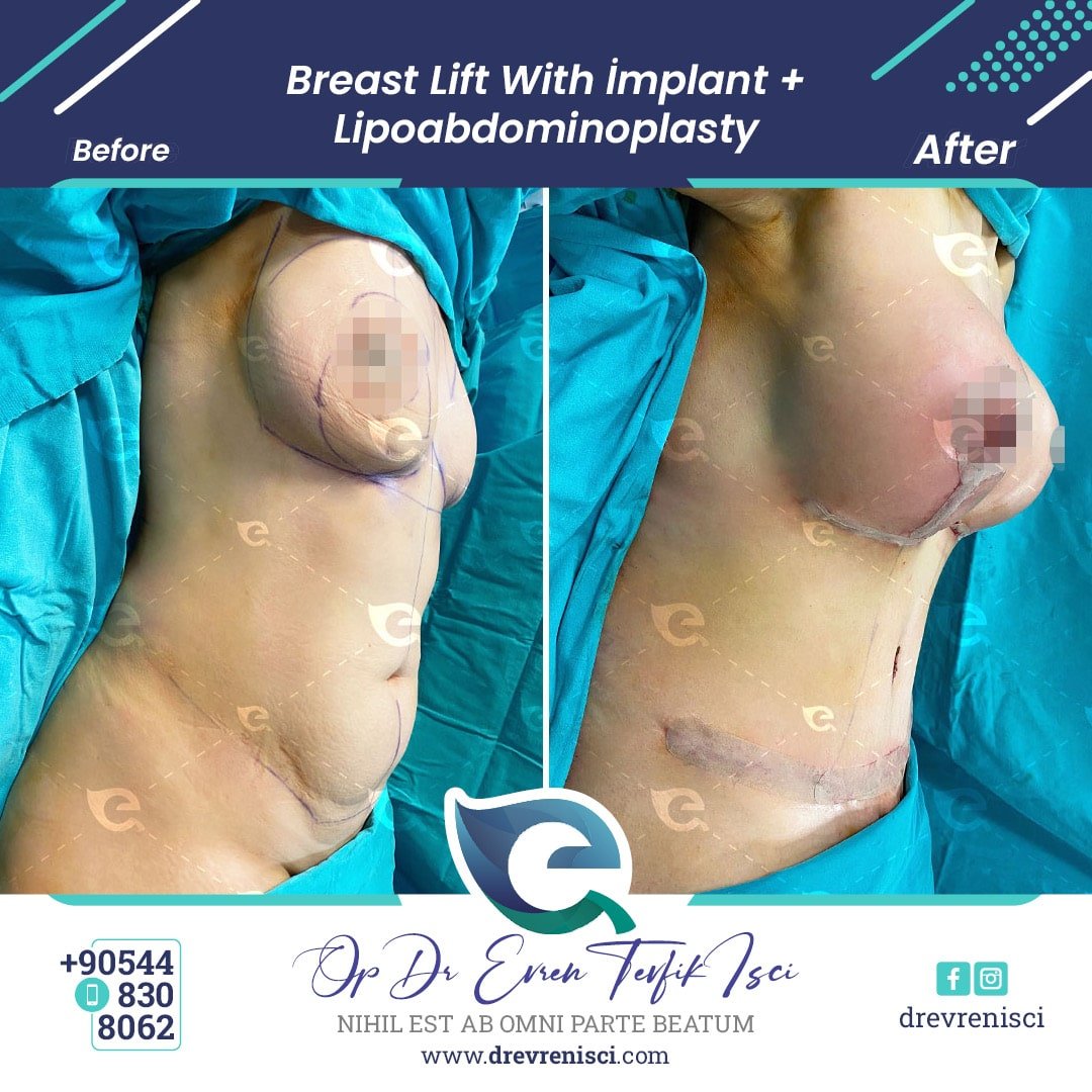 breast lift gallery