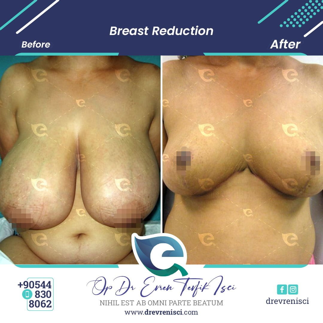 breast reduction gallery