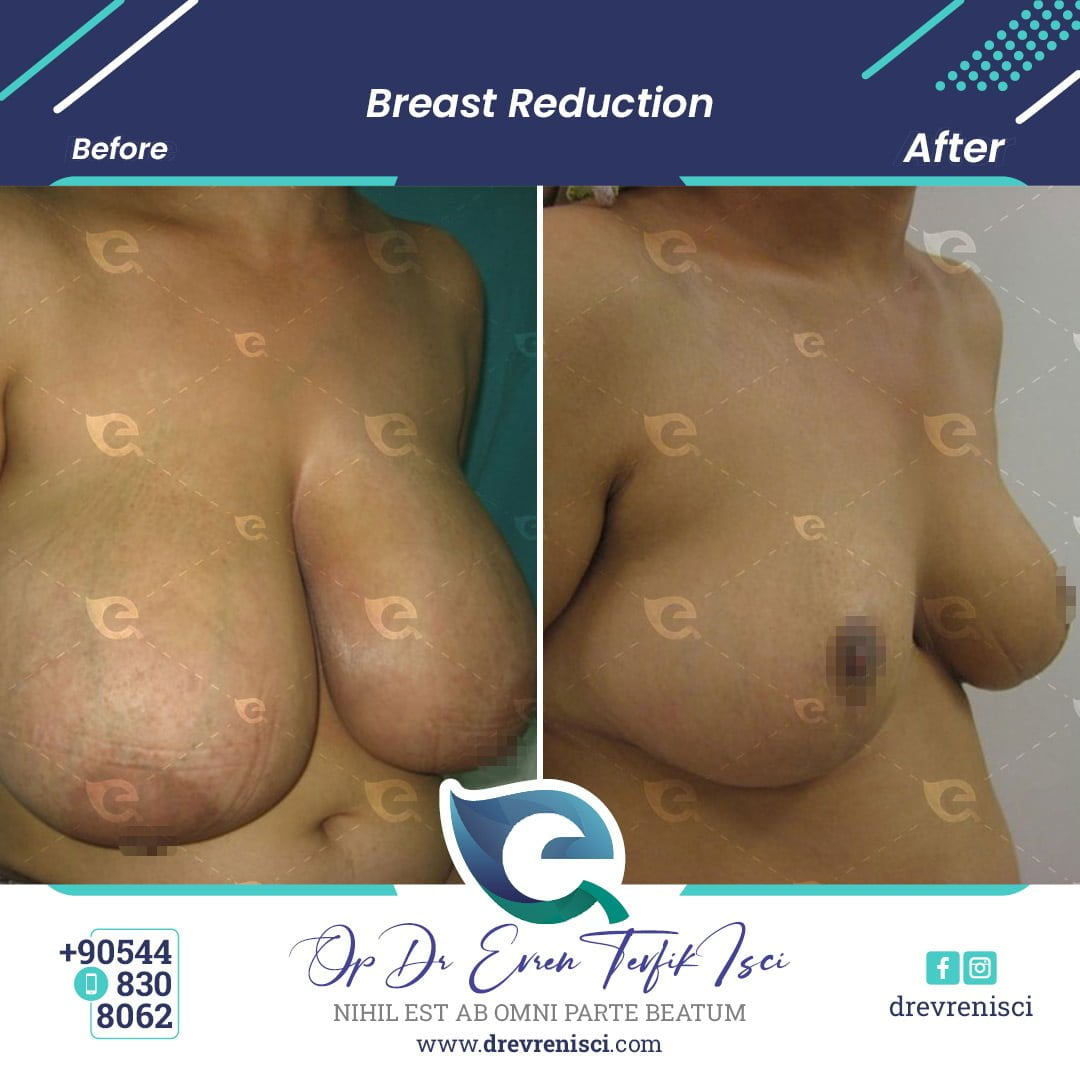 breast reduction galleryyy