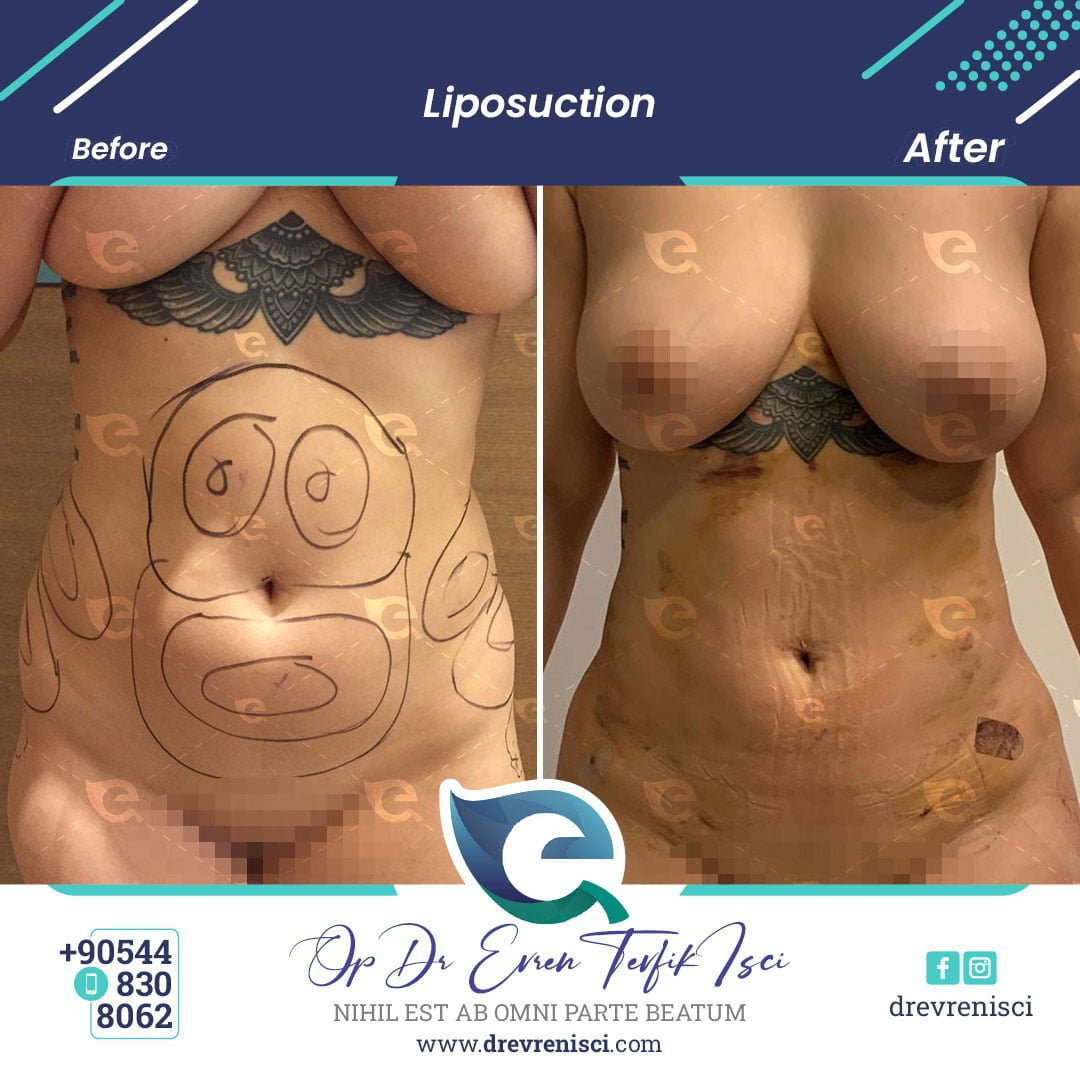 liposuction-galllery