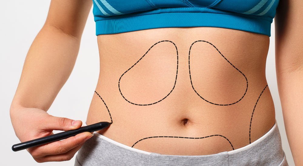 liposuction hangi bölgelere uygulanır