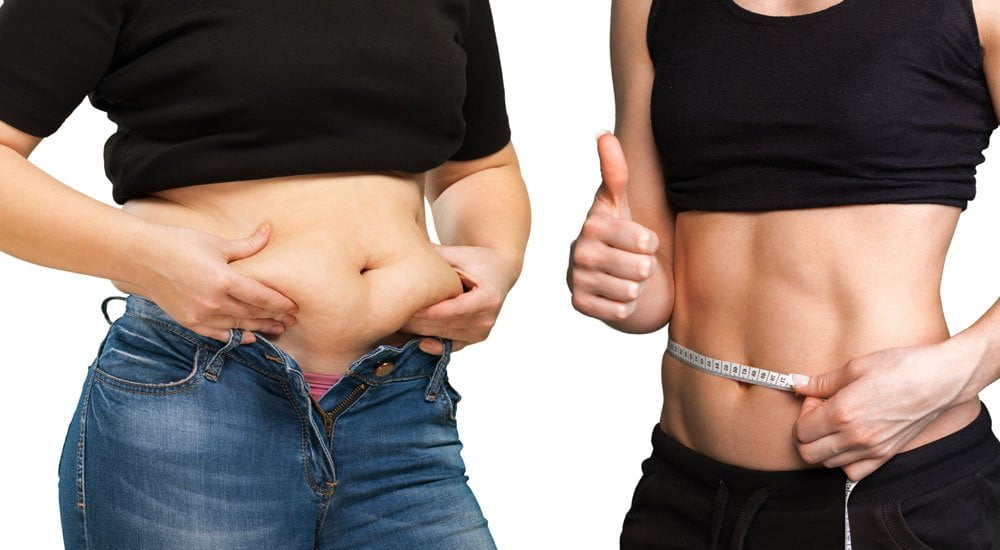liposuction öncesi ve sonrası