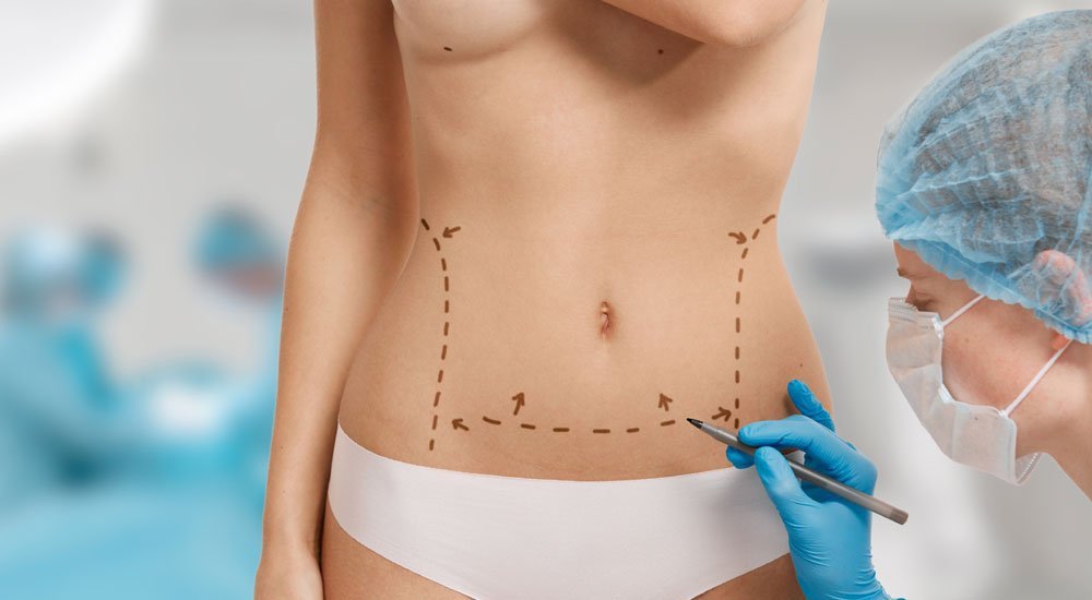liposuction vücut şekillendirme