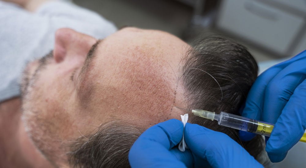 When Do Drowsiness and Pains Resolve After Hair Transplantation? » Op. Dr.  Evren İşçi