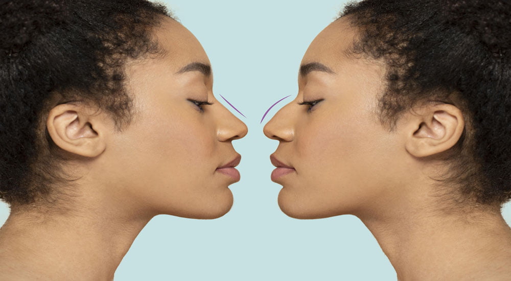 Why Does the Nose Tip Drop After Rhinoplasty?
